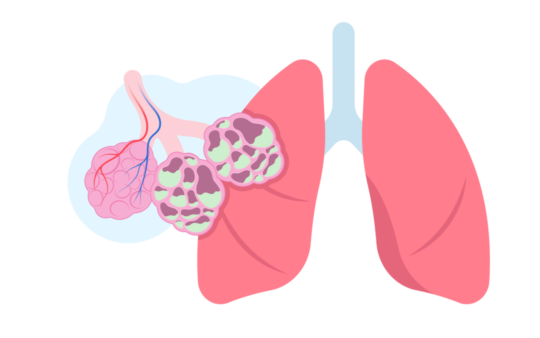 Prévention de la bronchiolite chez le nourrisson