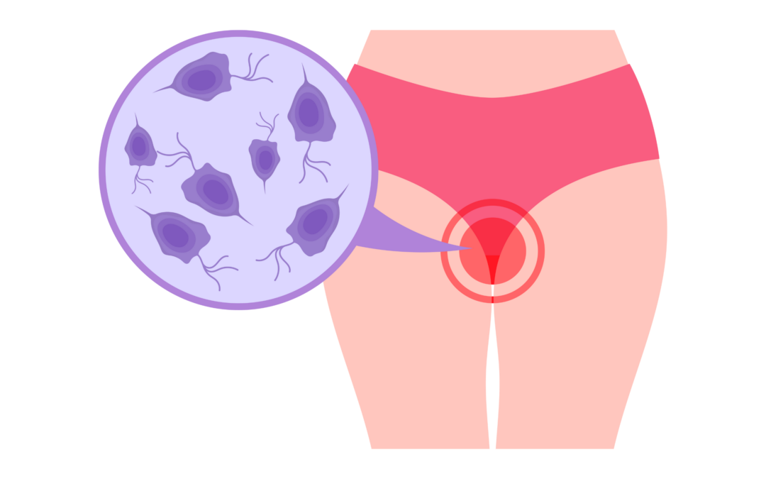 Mycoses vaginales : augmentation des résistances aux antifongiques azolés